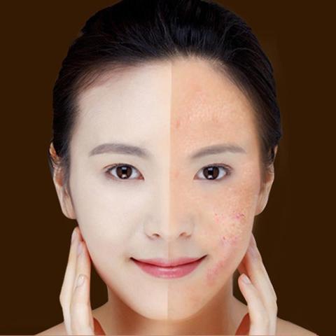Wrinkle Removal Treatment Device Skin Care Beauty Equipment
